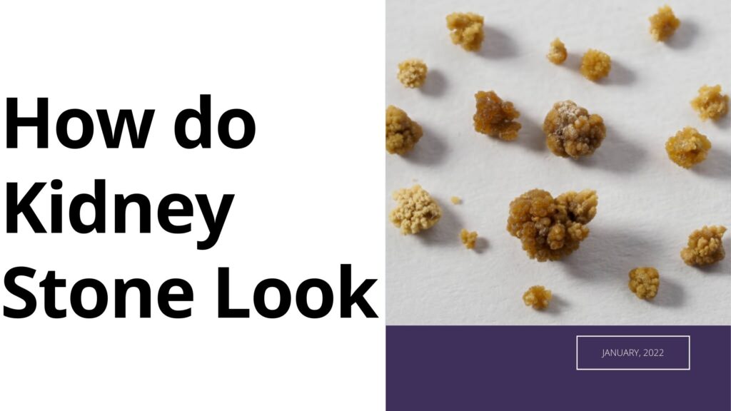 What does a kidney stone look like? Daily Care Blog