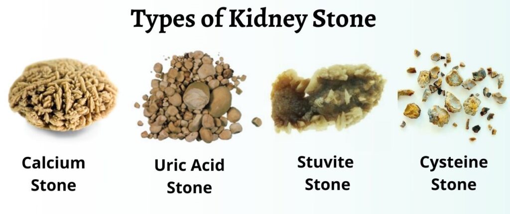 what-does-a-kidney-stone-look-like-daily-care-blog